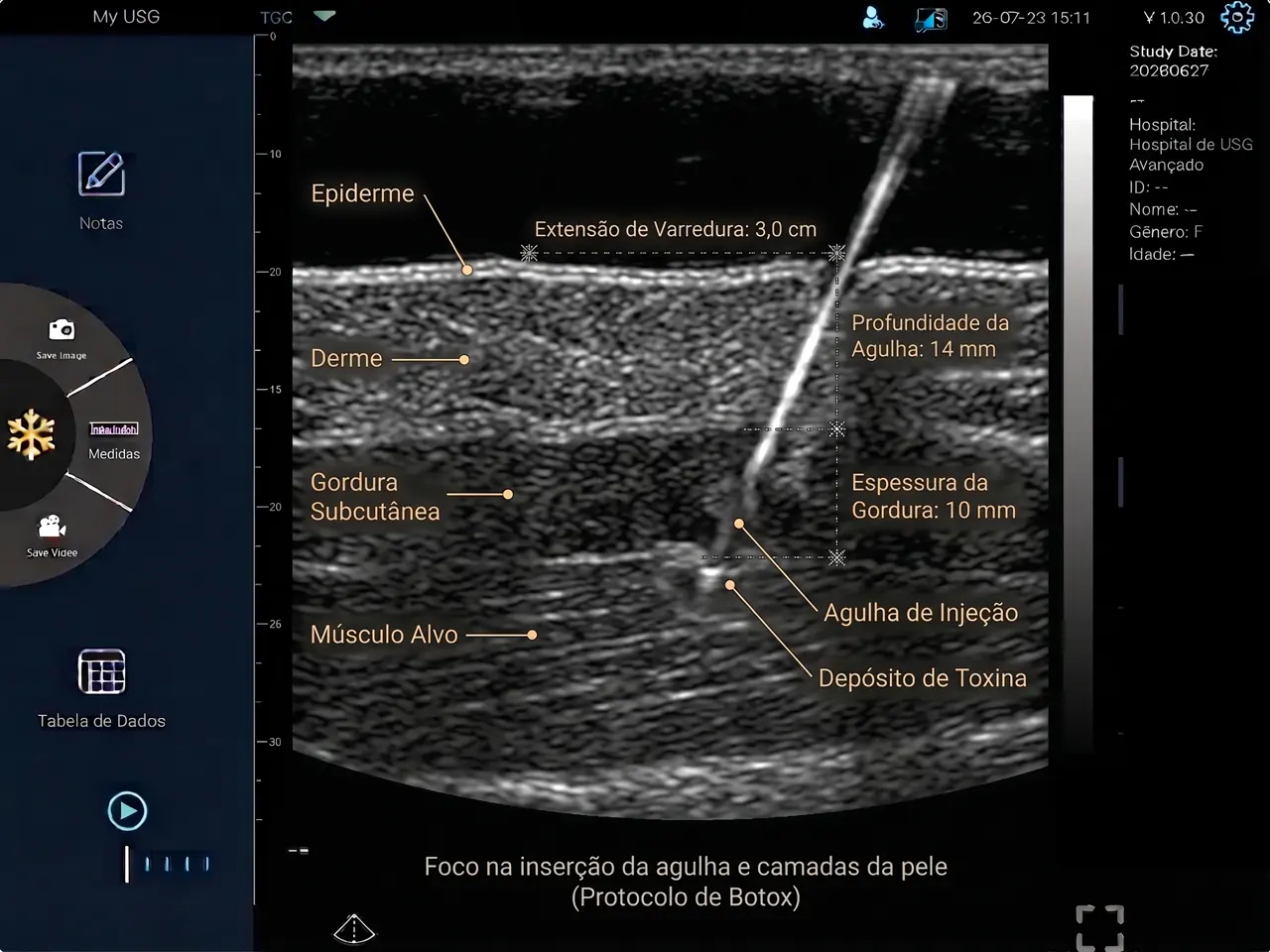 Imagem de ultrassom no app MYUSG identificando epiderme, derme, gordura subcutânea, músculo alvo, a agulha de injeção e o depósito de toxina, com medições de profundidade.